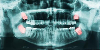 Dental x-ray showing wisdom teeth