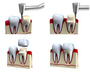 Diagram showing tooth crown procedure